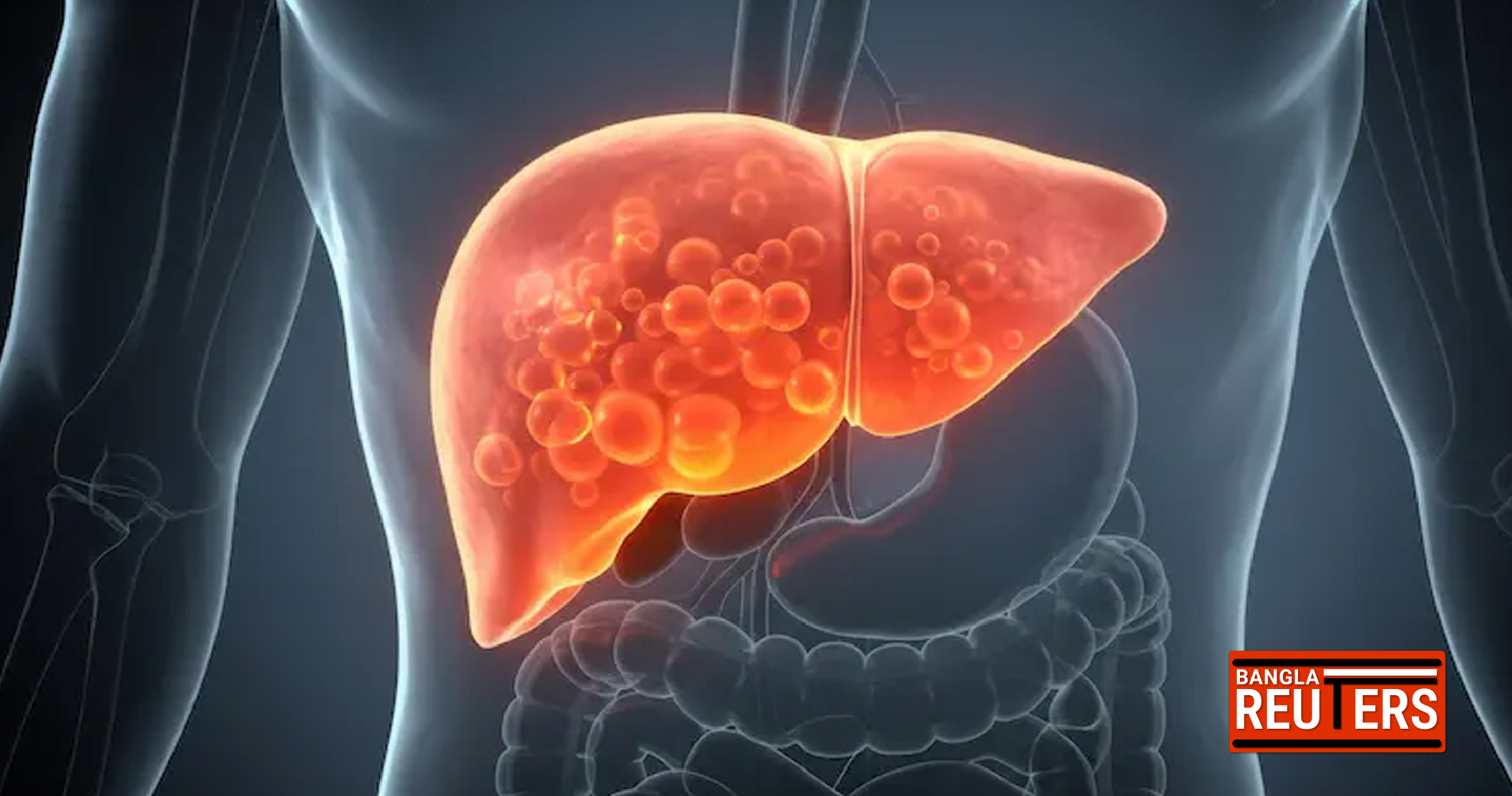 রোগা শরীরেও থাবা বসাচ্ছে ফ্যাটি লিভার: মাসে ঠিক কত লিটার তেল নিরাপদ?